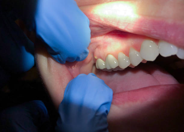 Best Emergency Dentist for Knocked-Out Tooth in Addison, TX